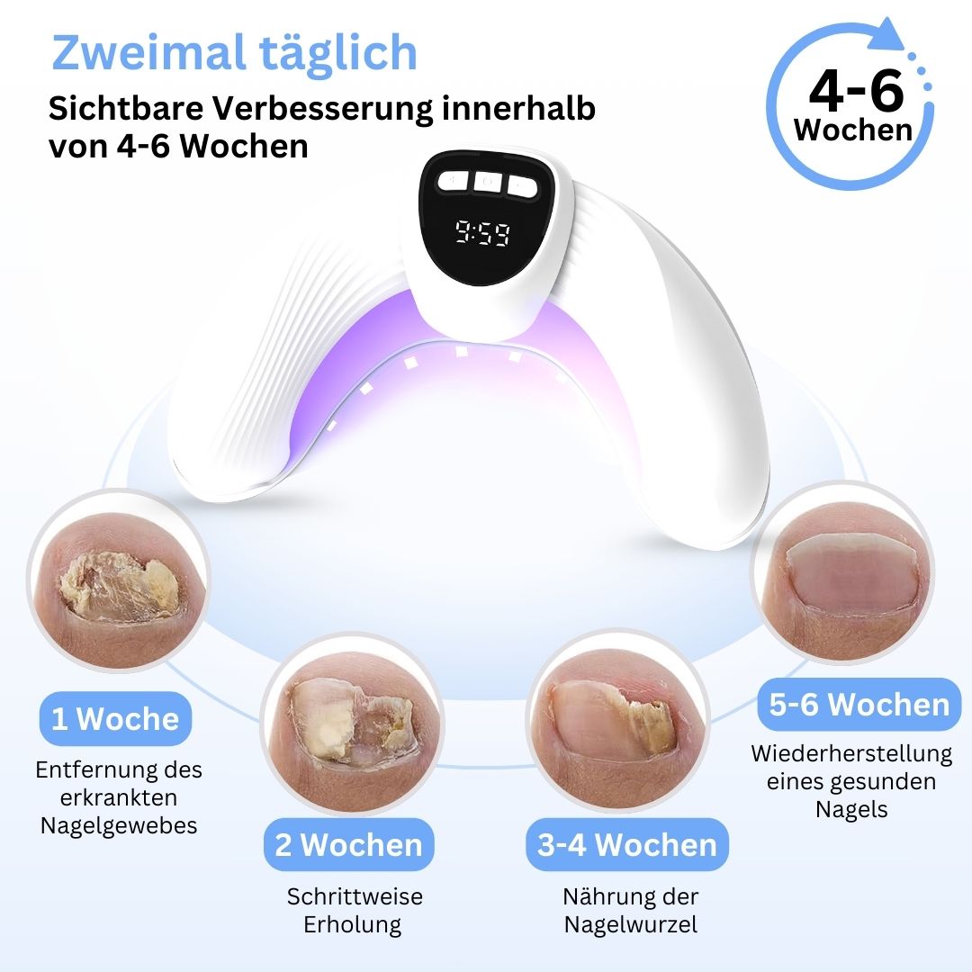 MykoCare - Innovative Lichtbehandlung gegen Nagelpilz