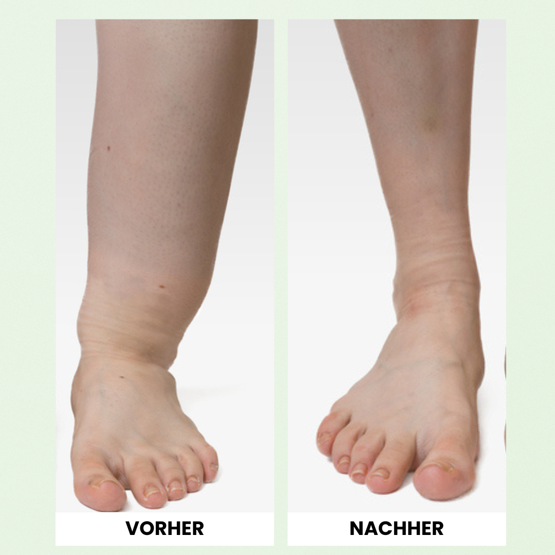 Vitaflow® Lymphatic - Therapiegerät gegen Lymphödeme und Wassereinlagerungen