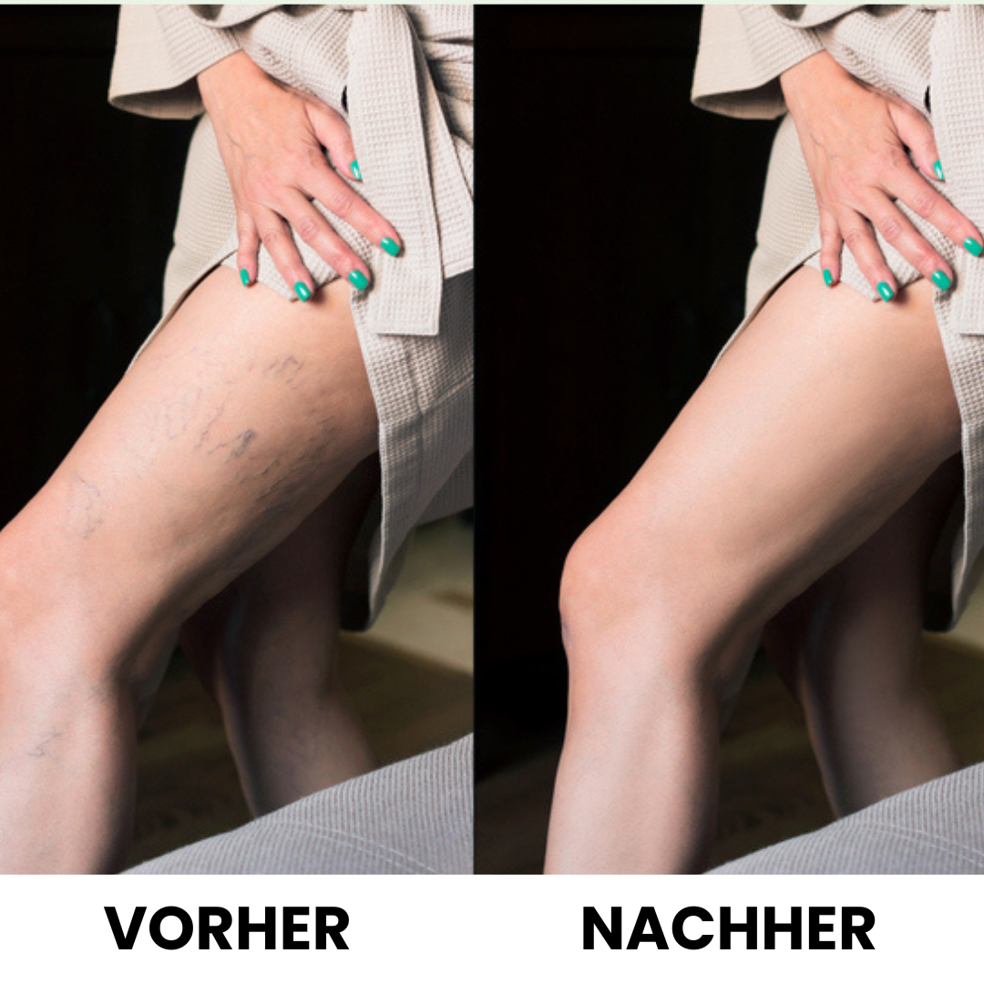 VenoPulse® Vibrationstherapie-Gerät bei Krampfadern