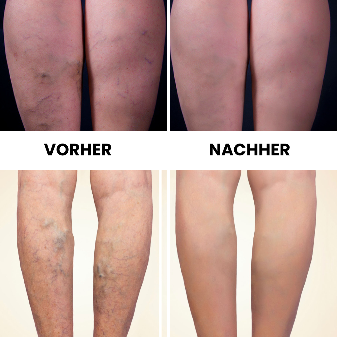 VenoPulse® Vibrationstherapie-Gerät bei Krampfadern